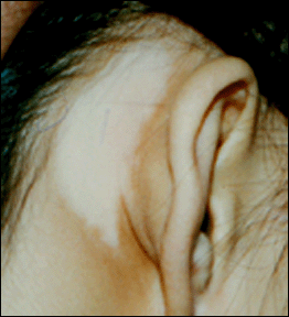 白癜风的白斑会长在耳朵上吗